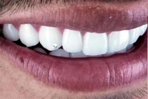 Grillz: la técnica que uso Alexis Vega para ponerse diamantes en los dientes  - Uno TV