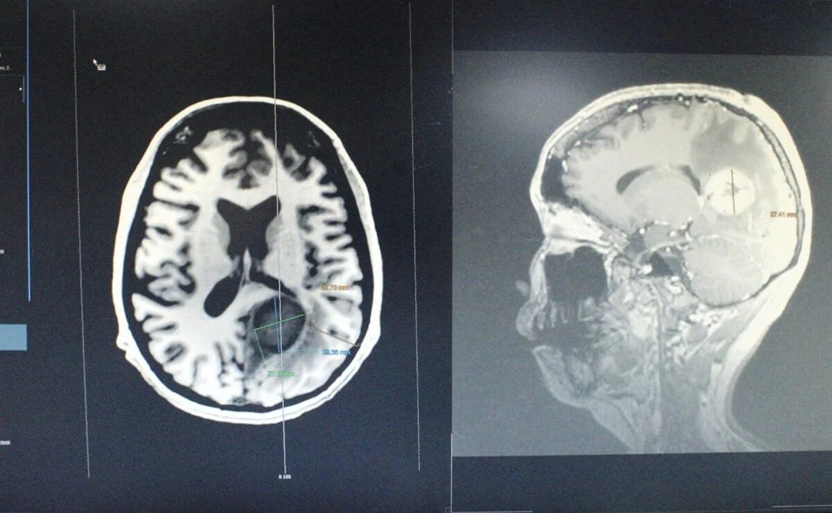Mujer iba por operación de vesícula pero le retiran tumor del tamaño de un huevo