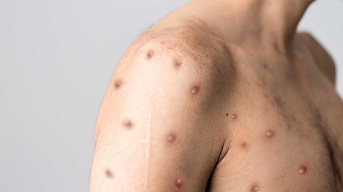 Viruela del mono: ¿Cómo prevenir el contagio?