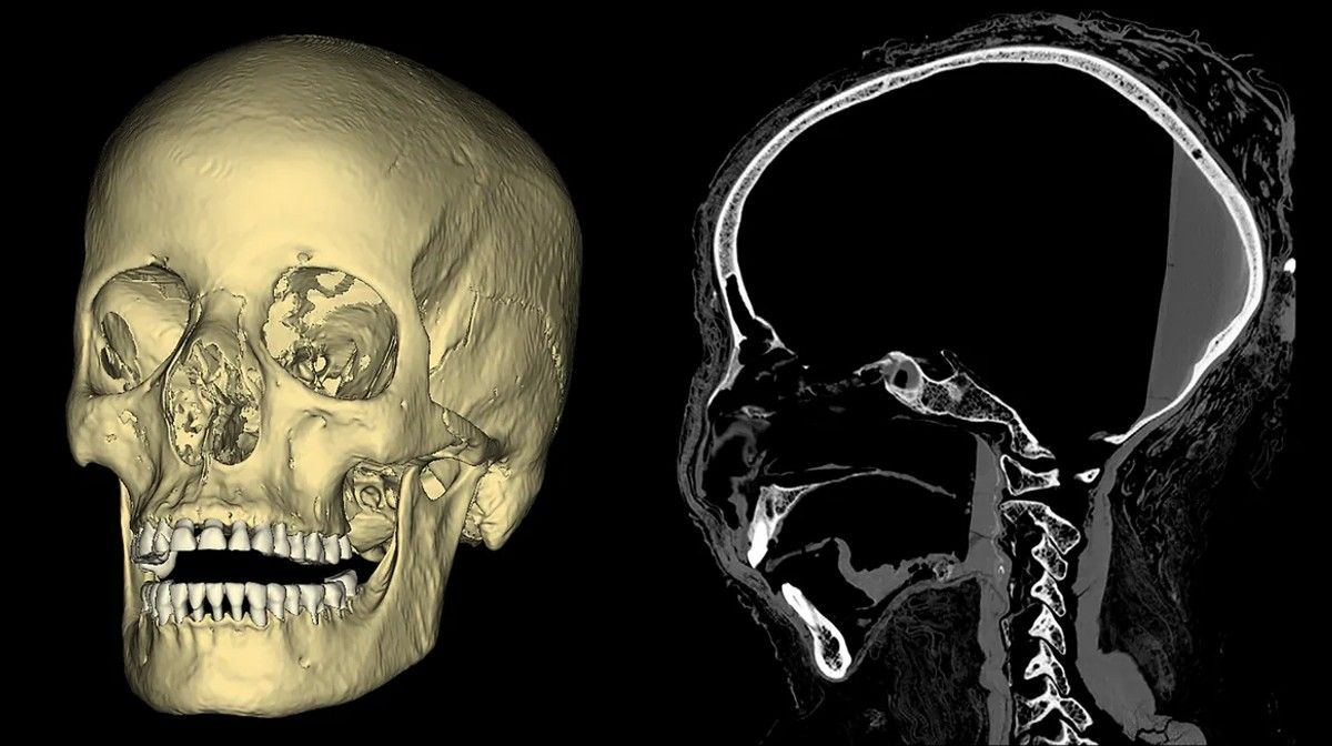 LA DAMA MISTERIOSA: LA MOMIA EGIPCIA QUE MURIÓ EMBARAZADA Y CON CÁNCER