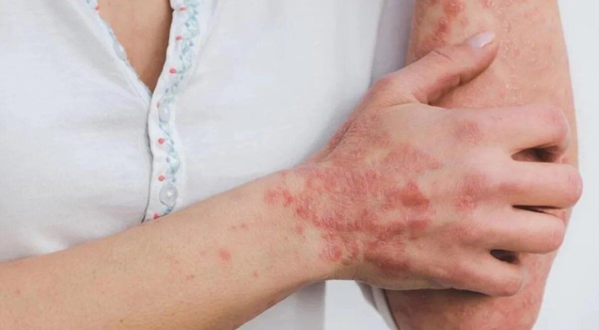 «No hay pruebas» de que la viruela del mono se contraiga por tocar superficies infectadas: estudio