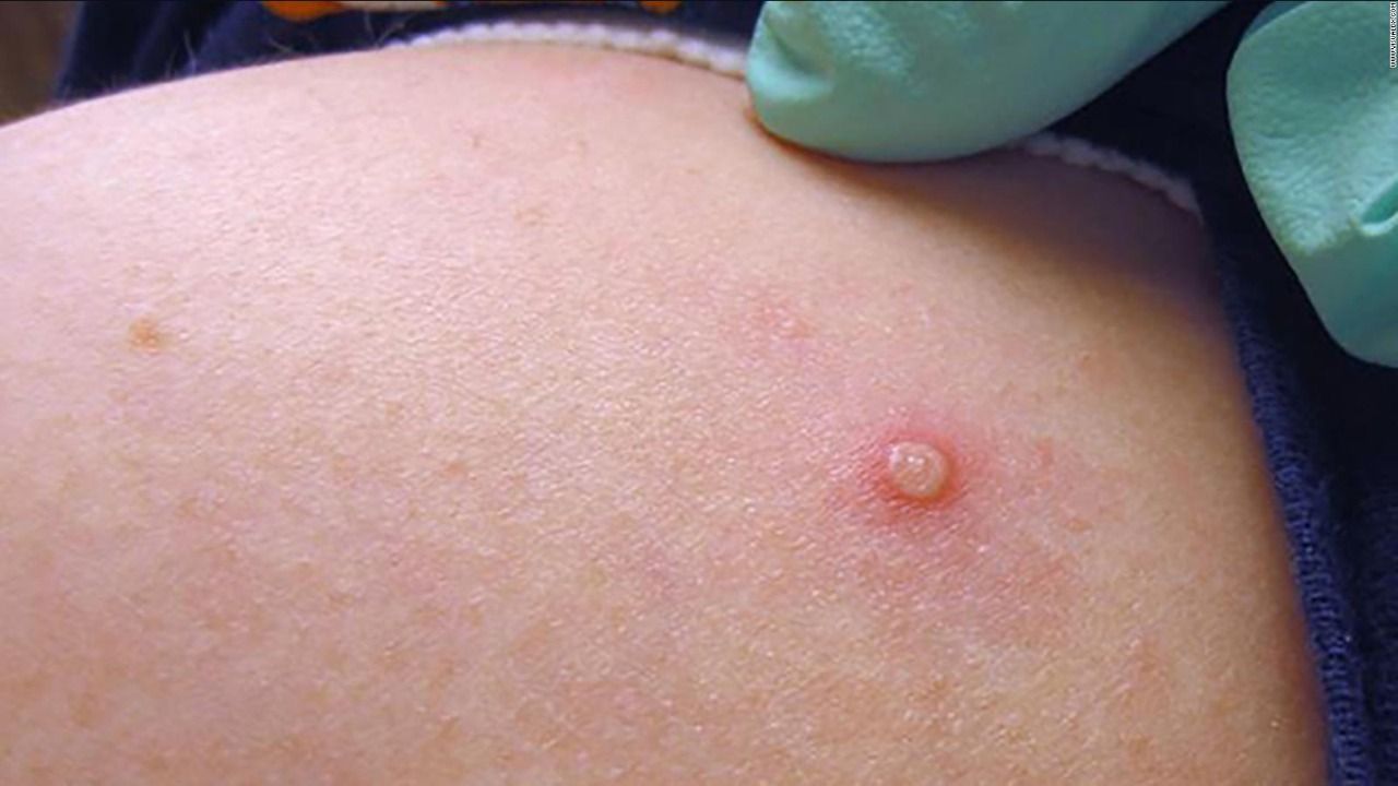 Investiga Salud tres casos sospechosos de viruela del mono