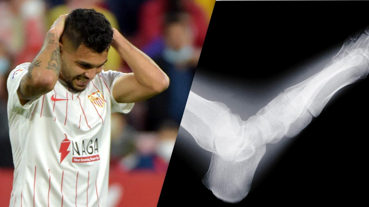 ¿Qué es la fractura de peroné y de ligamentos del tobillo que sufrió “Tecatito” Corona rumbo a Qatar 2022?