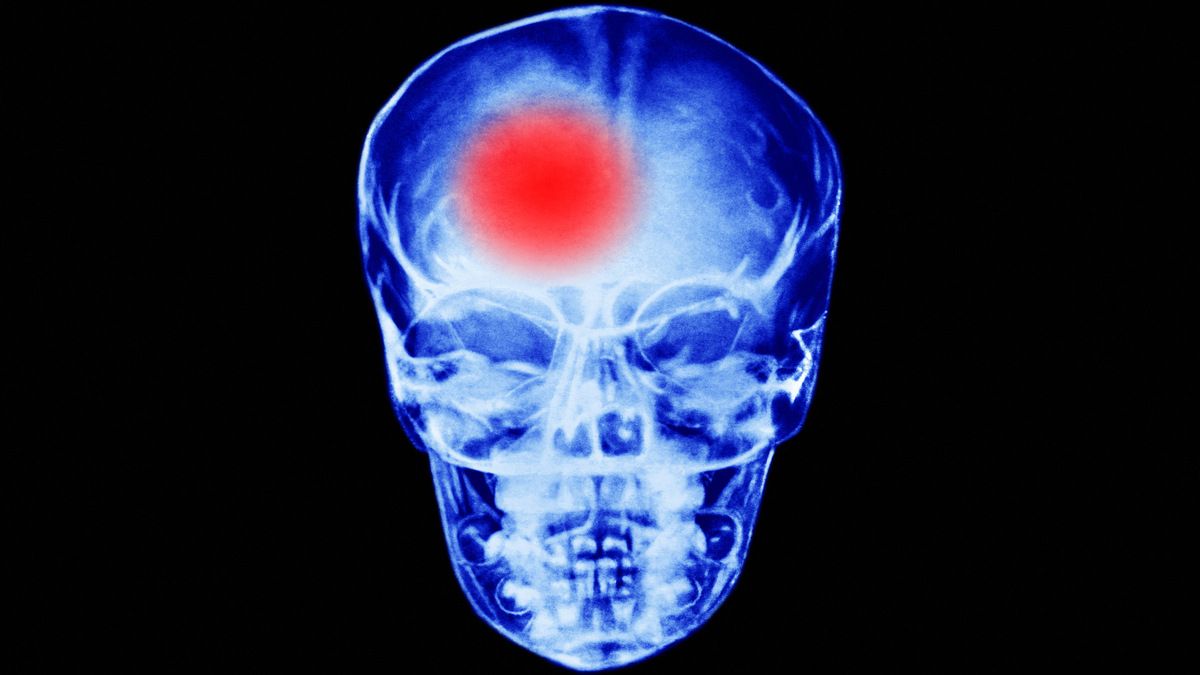 ¿Qué es un infarto cerebral, una de las principales causas de defunción en mayores de 65 años?