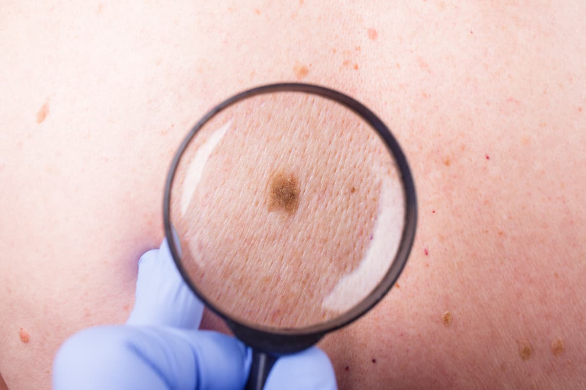 Qué es y cómo se trata el melanoma, un tipo de cáncer de piel que tiene el presidente de Ecuador, Guillermo Lasso