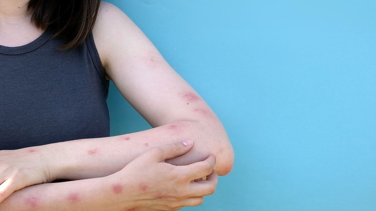 ¿Cómo tratar la dermatitis atópica más común?