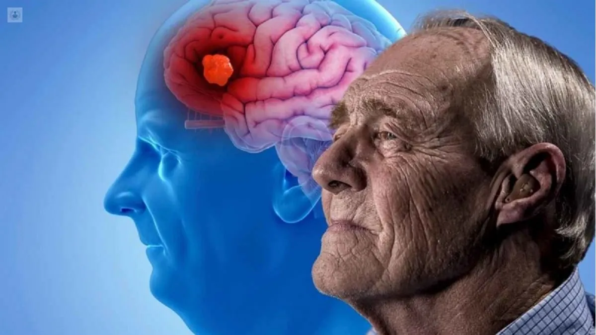 Científicos crean proteína modificada para acabar con el Alzheimer