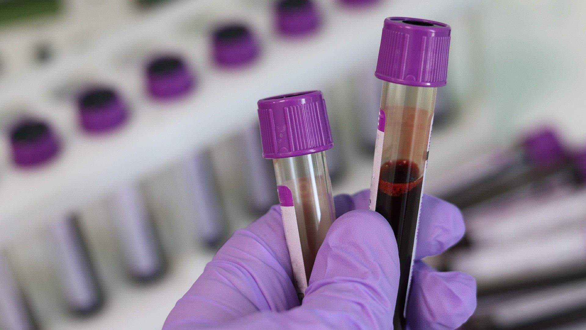 Nuevo análisis de sangre detecta Alzheimer antes de manifestarse