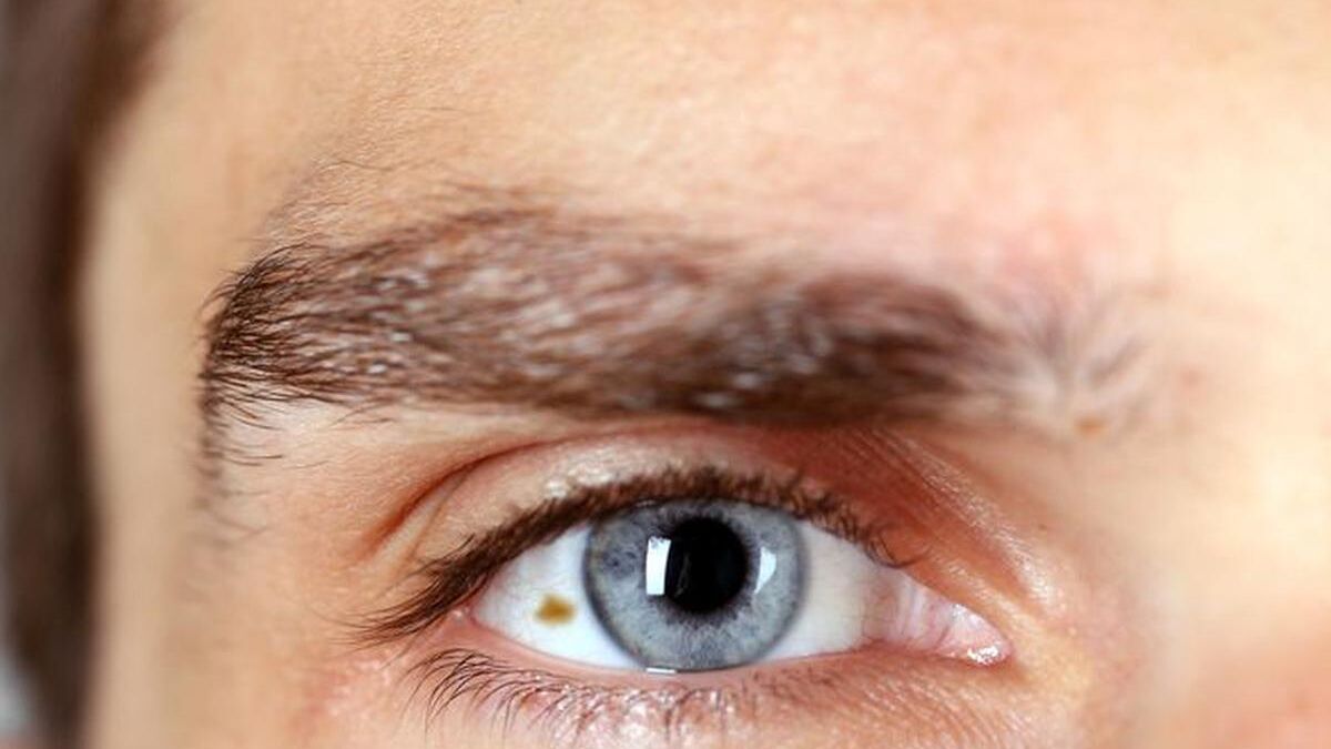 Síntomas y signos del cáncer de ojo que suele confundirse con una infección