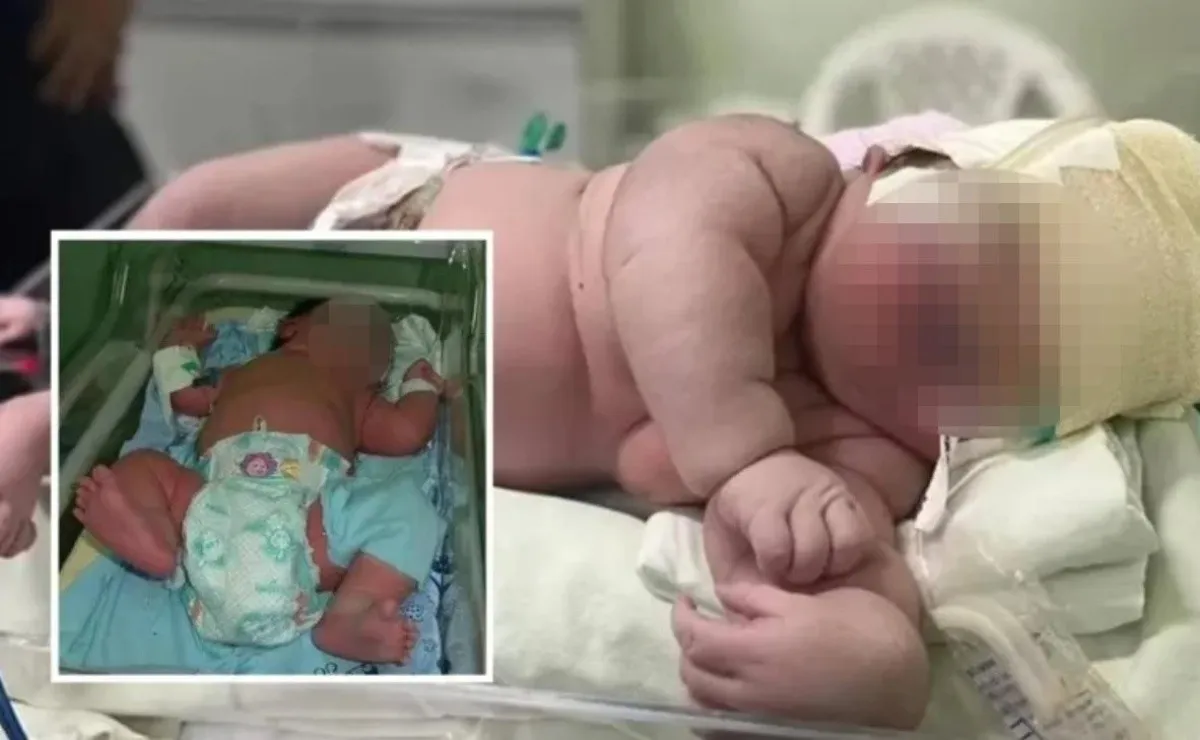 Nace bebé de 7.3 kg en Brasil: ¿Qué es la macrosomía, enfermedad que tiene el recién nacido?