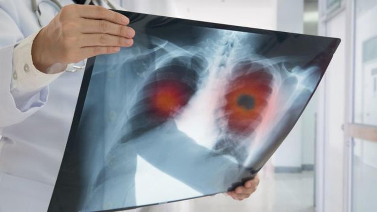 ¿La contaminación podría provocar cáncer de pulmón?