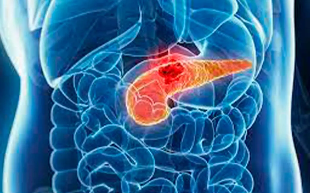 Vacuna experimental muestra resultados prometedores contra cáncer de páncreas