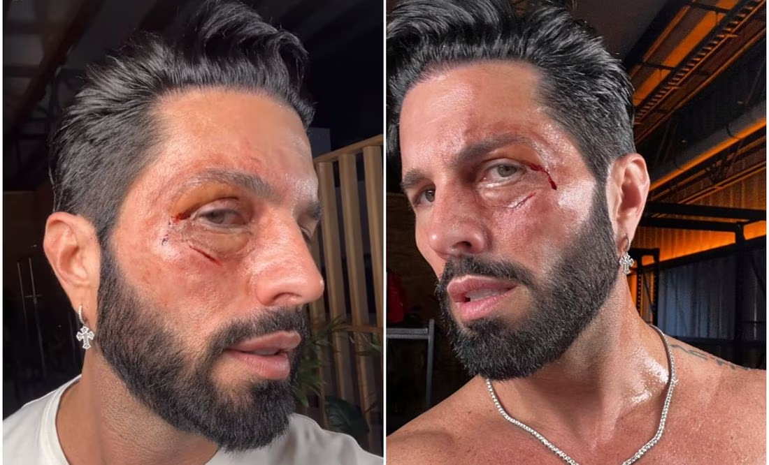 Poncho de Nigris aparece con el rostro golpeado, «culpa» a su mamá y a Adal Ramones
