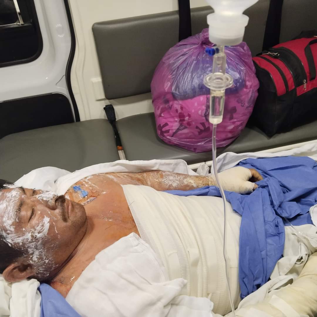 Grave hombre que sufrió quemaduras