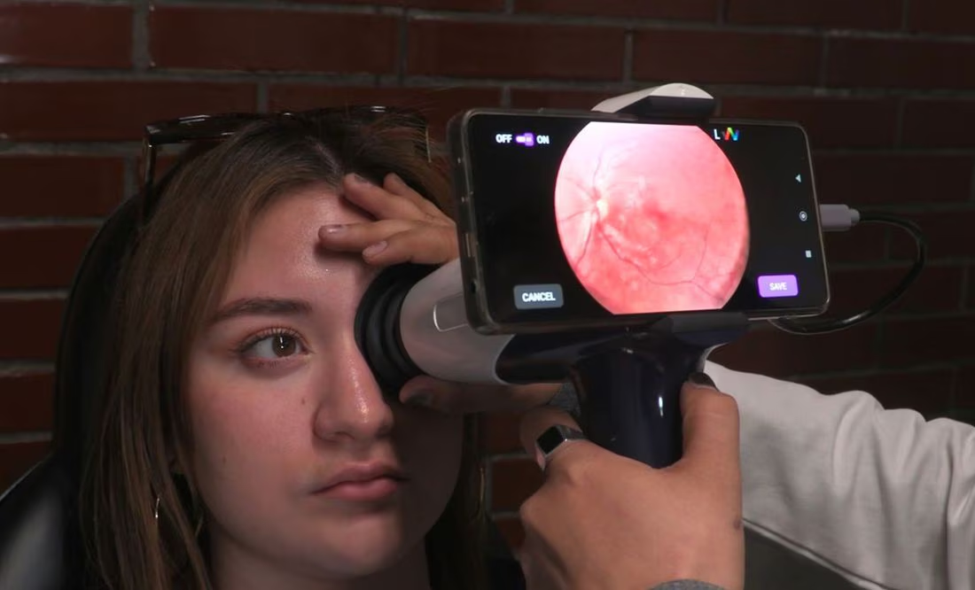 Glaucoma, enfermedad silenciosa que suele diagnosticarse cuando el daño es avanzado