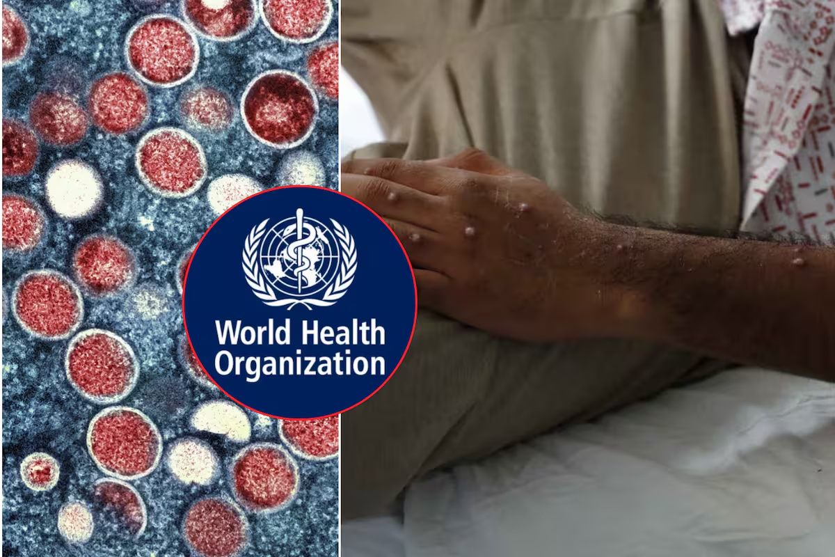 Viruela del Mono: OMS declara emergencia sanitaria internacional por Mpox, ¿qué significa y dónde hay aumento de propagación?