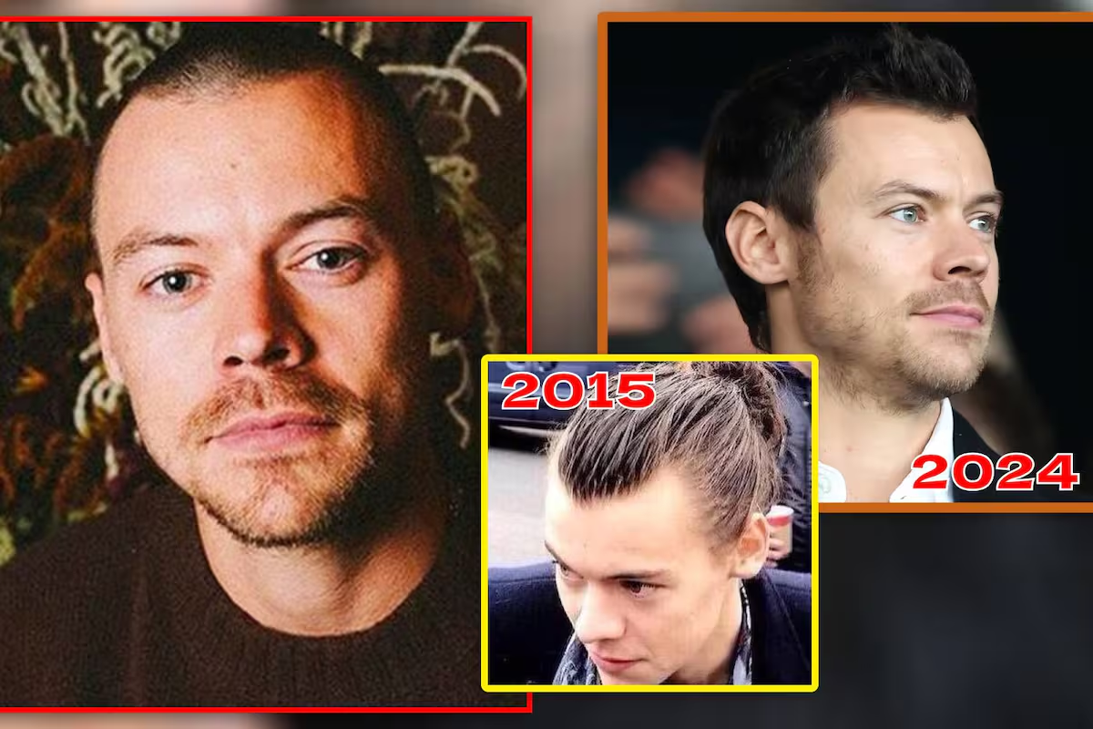 Cirujano plástico revela la razón por la que Harry Styles se rapó el año pasado y analiza si valió la pena