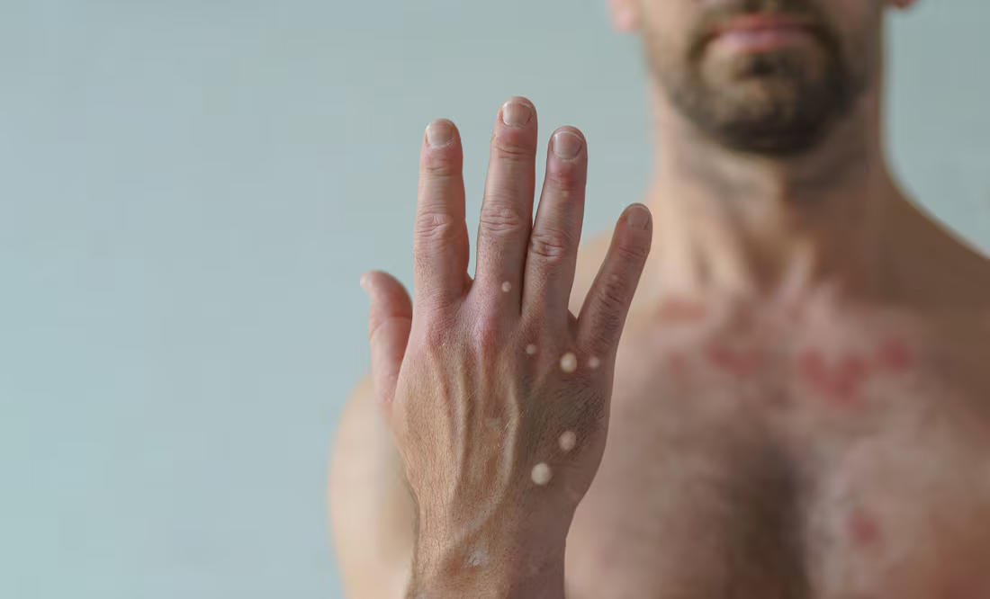 Detectan en Francia primer caso de la nueva variante de mpox; autoridades investigan origen del contagio