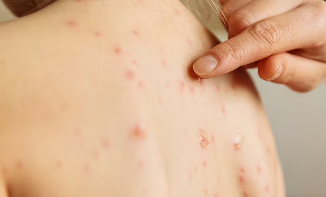 ¿Qué es y cuáles son los síntomas del sarampión?; Conave emite aviso epidemiológico por 21 casos en México