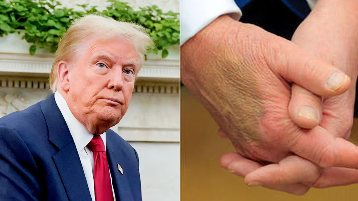 Trump: Esto sabemos de los moretones del presidente de EU