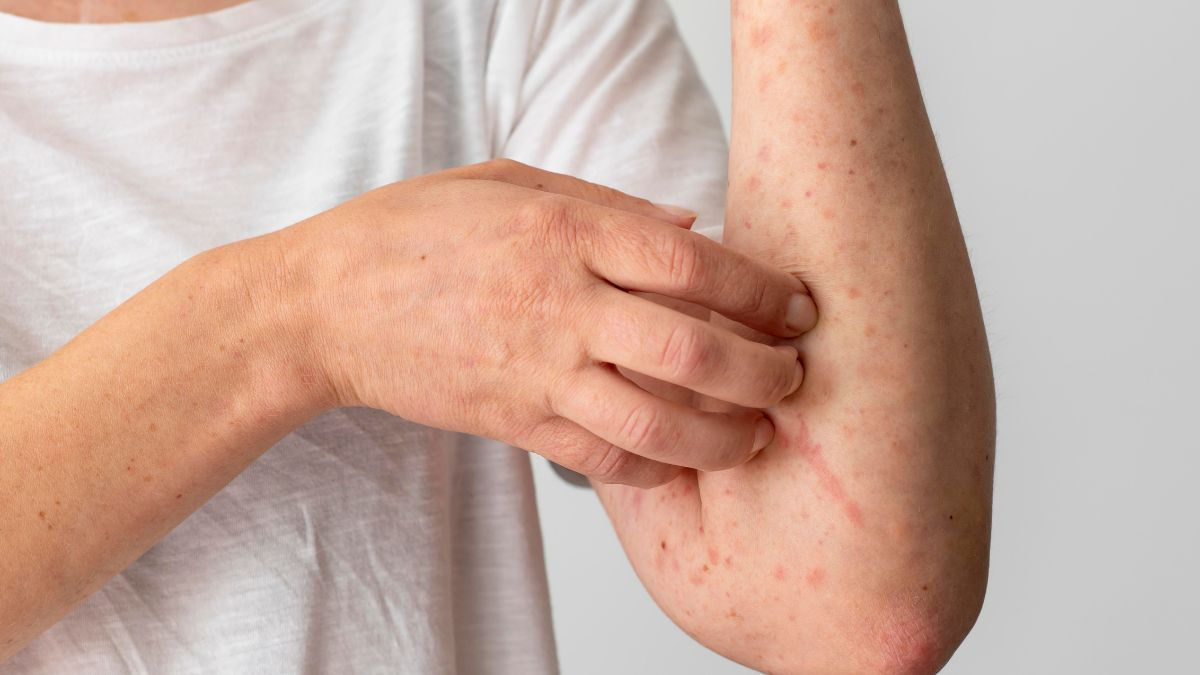 Yucatán confirma 10 casos de sarampión; ocupa en lugar 28 en tabla nacional de contagios
