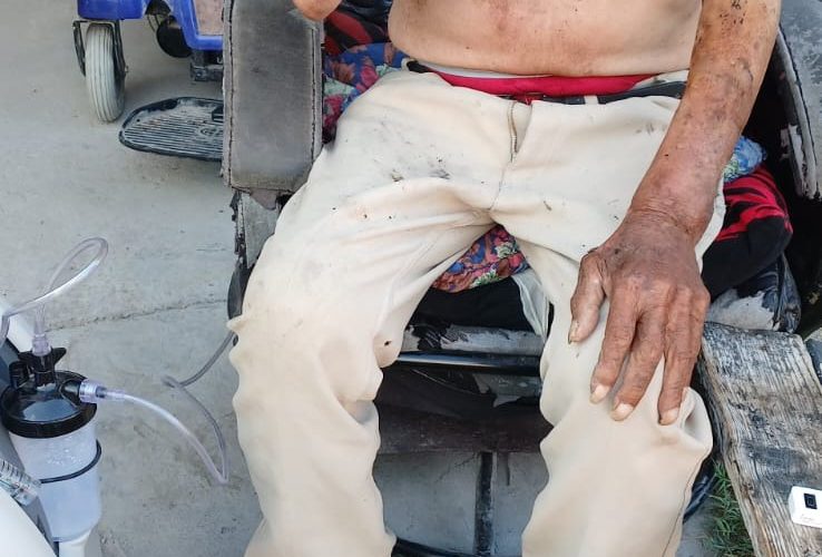 Fallece adulto mayor que le explotó un tanque de oxigeno