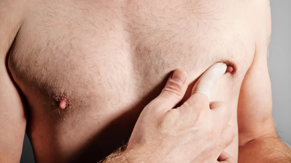 Hombres representan el 1% de los casos de cáncer de mama en México, pero su detección llega tarde: ¿Cuáles son las señales de alerta?